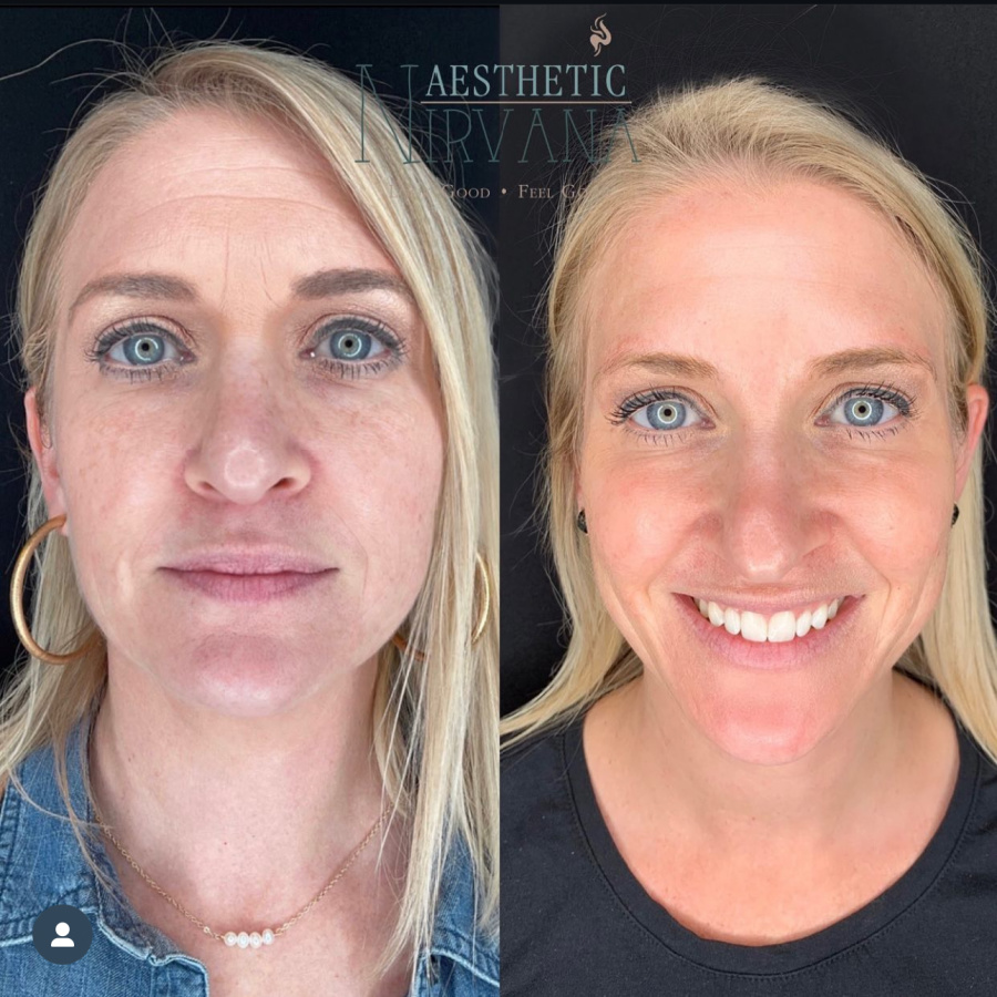 Before and after neurotoxin injections at Aesthetic Nirvana
